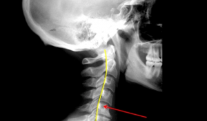 neck-align